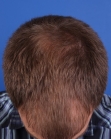 Before Hair Transplant&nbsp;Front
